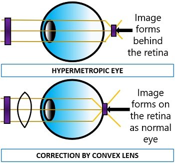 Correction of hypermetropic eye