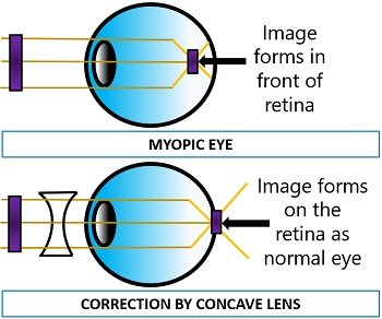 Correction of myopic eye