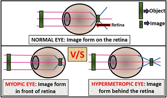 myopia és hyperopia egyszerre van